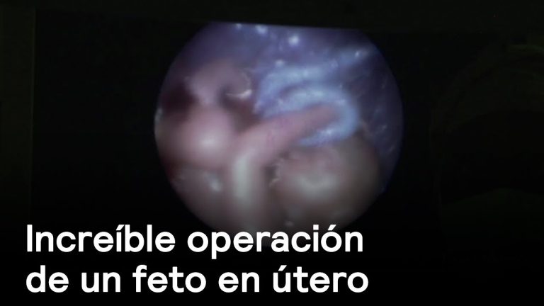 Asombrosa intervención fetal en hospital: realizan operación intrauterina a bebé