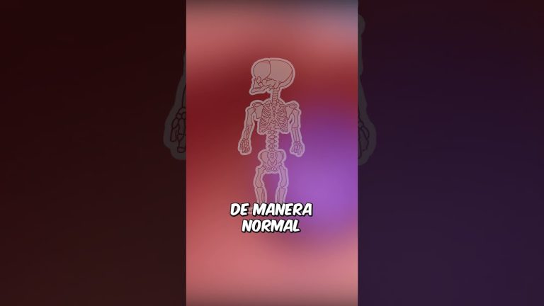 Desafíos y tratamiento de la acondroplasia, el tipo más común de enanismo