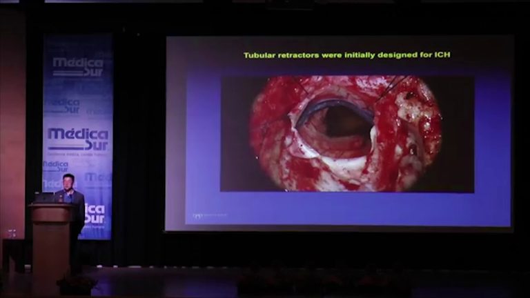 Cómo las células inmunitarias se convierten en aliadas de la metástasis cerebral: el asombroso proceso.