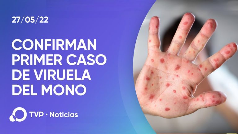 Detectan el primer caso en Argentina de la variante más agresiva y contagiosa de la "viruela del mono".