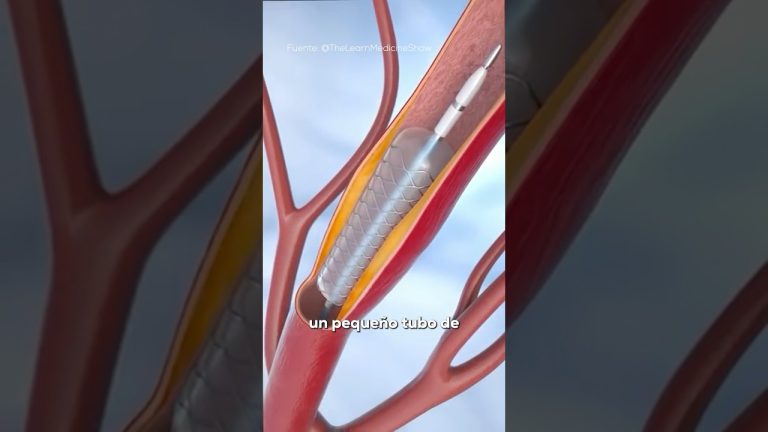 Progreso en cirugías del corazón con stents degradables, pero señalan inconvenientes para adultos