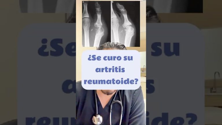 Confirman que un medicamento para la artritis tambi&eacute;n previene la p&eacute;rdida de cabello m&aacute;s intensa